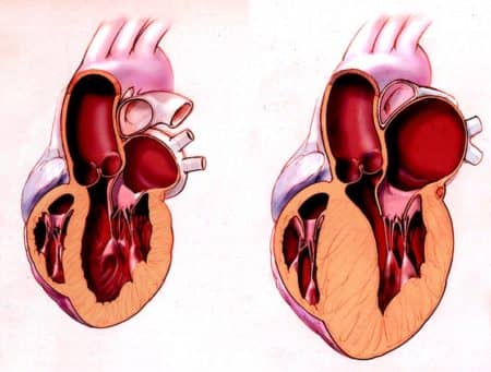 Особливості діагностики та лікування інфаркту міокарда