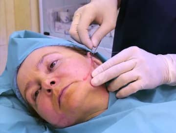 Ефективність, результати та переваги підтяжки шкіри золотими нитками для особи, фото до і після процедури