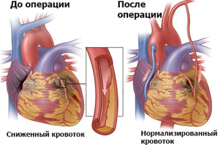 Шунтування – операція на серці