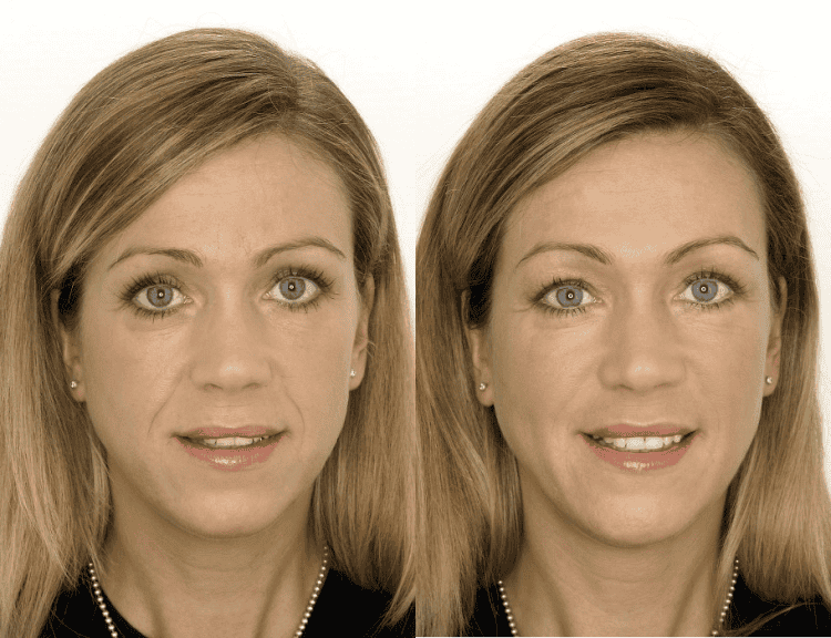Безінєкційна мезотерапія обличчя — що це таке і як комфортно і без уколів стати молодше