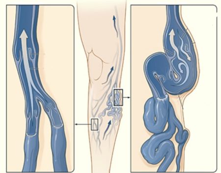 Симптоми і лікування при венозної недостатності нижніх кінцівок
