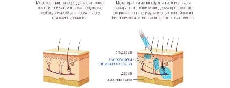 Що таке мезотерапія волосистої частини голови і як це допомагає прекрасній половині людства