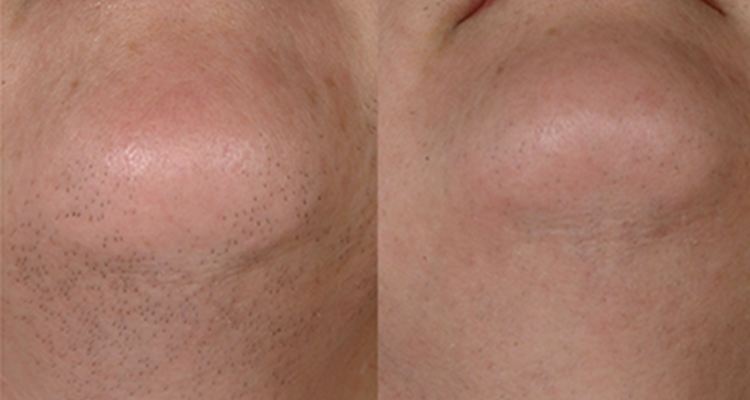 Особливості застосування фотоепіляції на обличчі — як надовго зробити шкіру ніжною і гладкою, відгуки про процедуру
