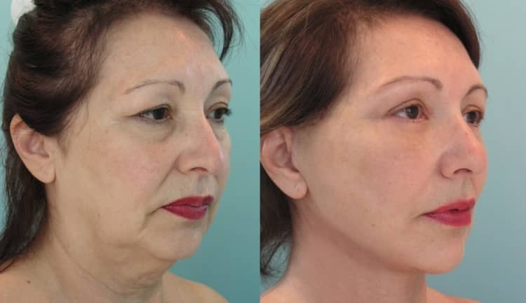 Стек гілок ліфтинг обличчя після 50 років — ефективна альтернатива пластичної хірургії