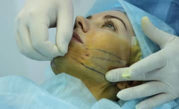 Стек гілок ліфтинг обличчя після 50 років — ефективна альтернатива пластичної хірургії