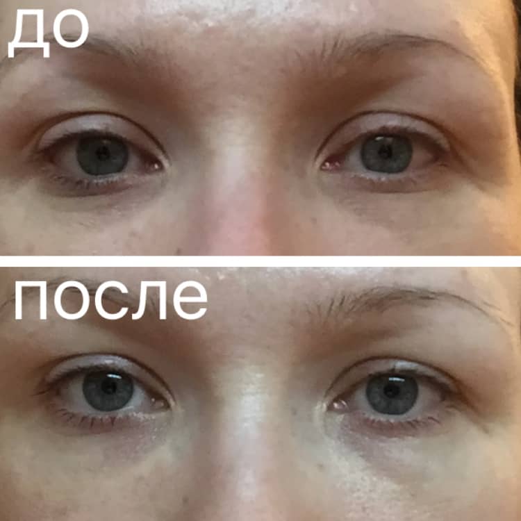 Застосування філлеров під очима і в області носослезной борозни, фото до і після інєкцій молодості