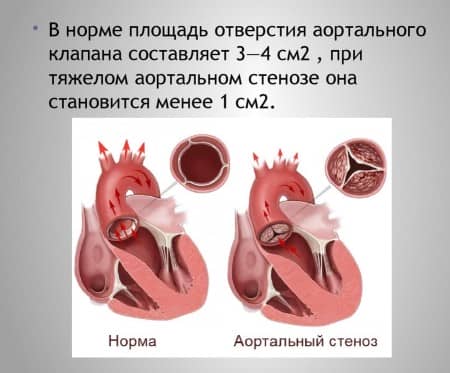 Особливості та види аортального стенозу
