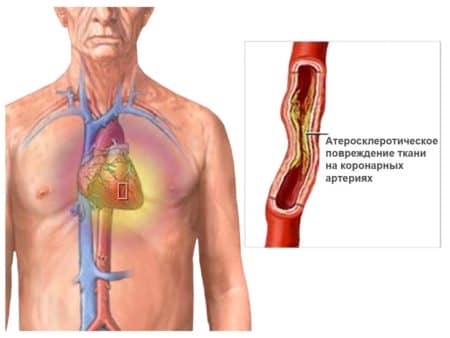 Що необхідно знати про стентування судин серця?