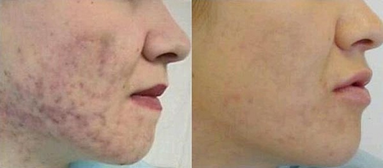 Процес оновлення шкіри обличчя за допомогою хімічного пілінгу — відгуки, як працює і для чого потрібно