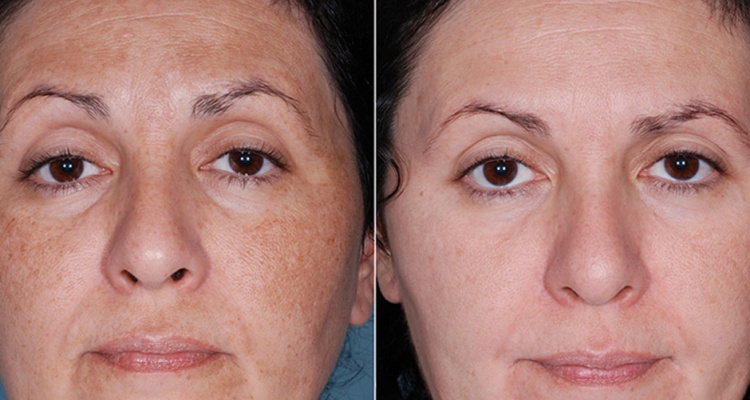 Як виконується глибокий хімічний пілінг обличчя, плюси і мінуси, фото до і після процедури