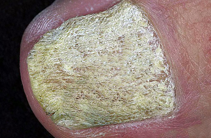 Псоріаз нігтів, лікування та різновиди такого захворювання (фото)