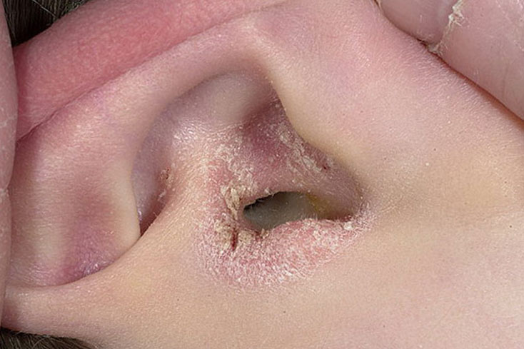 Псоріаз у вухах, профілактика і лікування вушного псоріазу