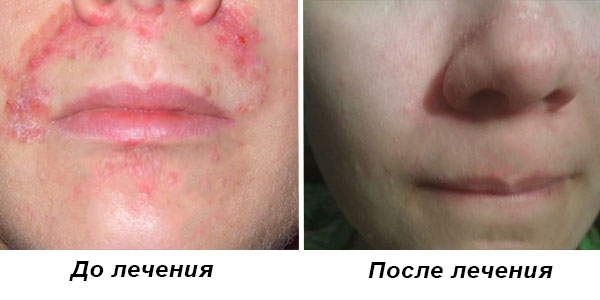 Себорейний псоріаз на обличчі – передумови, діагностика і лікування
