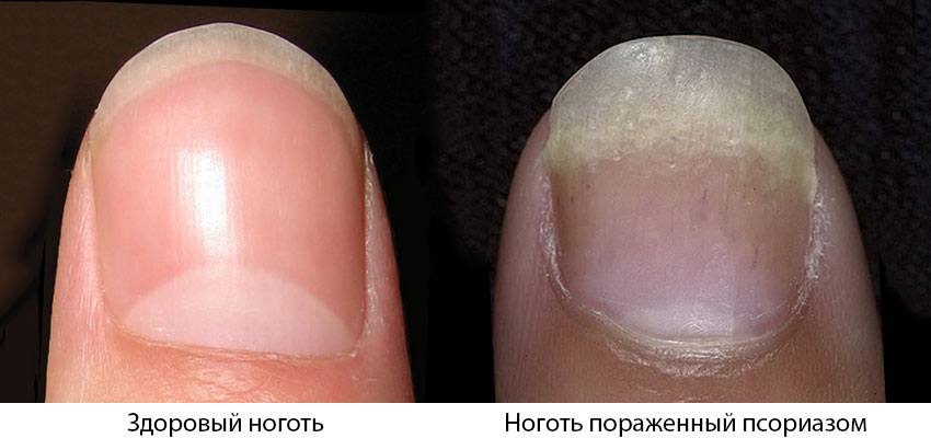 Поразка нігтів при псоріазі: Симптоми, лікування та профілактика