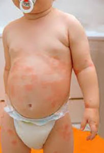 Як виглядає псоріаз у дітей: Причини і симптоми захворювання