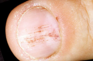 Поразка нігтів при псоріазі: Симптоми, лікування та профілактика