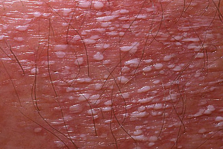 Ускладнення псоріазу: Типи, форми і прояви на шкірі (фото)