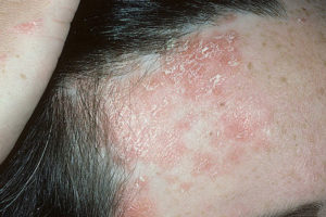 Хвороба шкіри псоріаз, від чого виникає і як проявляється (фото)