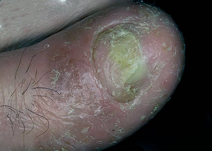Псоріаз на пальцях ніг. Стадії, симптоми та причини захворювання