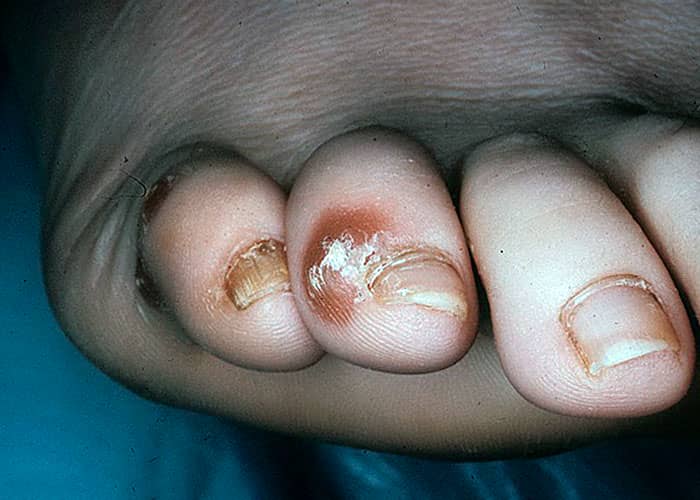 Псоріаз на пальцях ніг. Стадії, симптоми та причини захворювання