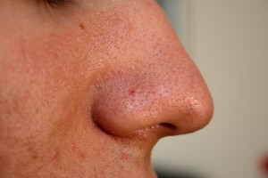 Розширені пори на обличчі: очищення та звуження пор