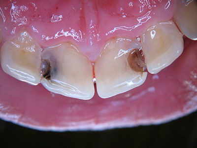 Карієс на передніх зубах, з внутрішньої сторони верхніх різців у дорослих