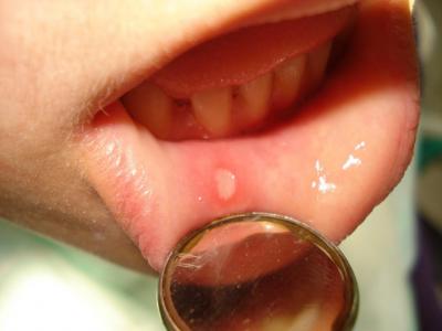 Стоматит: заразний чи ні у дітей, як передається від дитини, інкубаційний період у роті, чи можна заразитися цим дорослому
