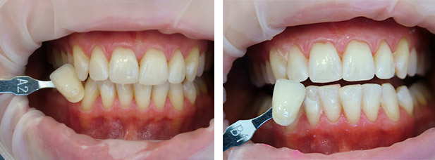 Різновиди лазерного відбілювання зубів, переваги і недоліки