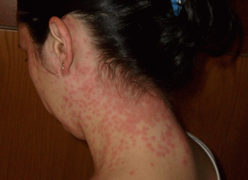 Алергія на сонце або фотодерматит (фотодерматоз)