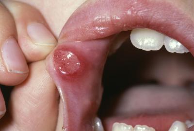 Антибіотики при стоматиті у дорослих: після лікування захворювань порожнини рота, лікується, чи потрібно пити ліки, можна лікувати