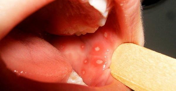 Стоматит: симптоми і лікування у дітей перші ознаки у роті на фото, як проявляється у дитини 2 років, дитяча профілактика