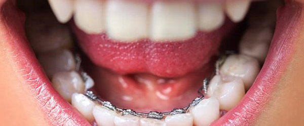 Лінгвальні брекети: що це таке, установка невидимою, внутрішньої, непомітною системи incognito в стоматології, фото до і після