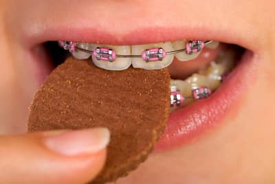 Що можна їсти з брекетами на зубах: список, харчування, рецепти, чому заборонено морозиво, через скільки після установки їсти