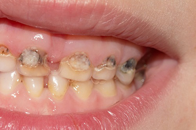 Пульпіт: лікування у дітей, що це таке, біологічні методи, як лікувати у дитини постійні зуби з несформованими коренями