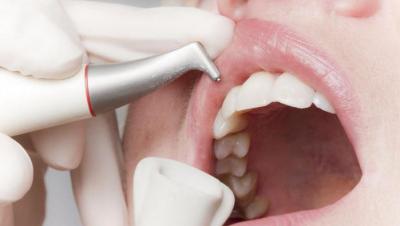 Боляче видаляти зубний камінь: варто чистити зуби в стоматології чи ні, як проходить видалення, чому потрібно прибирати наліт