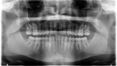 Імплантація зубів: знімок, який роблять перед операцією і для чого потрібен рентген імплантів зубів