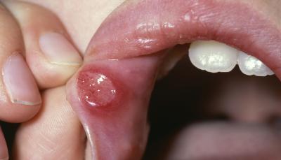 Ацикловір при стоматитах у дітей та дорослих у роті: мазь від інфекції, таблетки, дозування для дитини, можна мазати проти болю