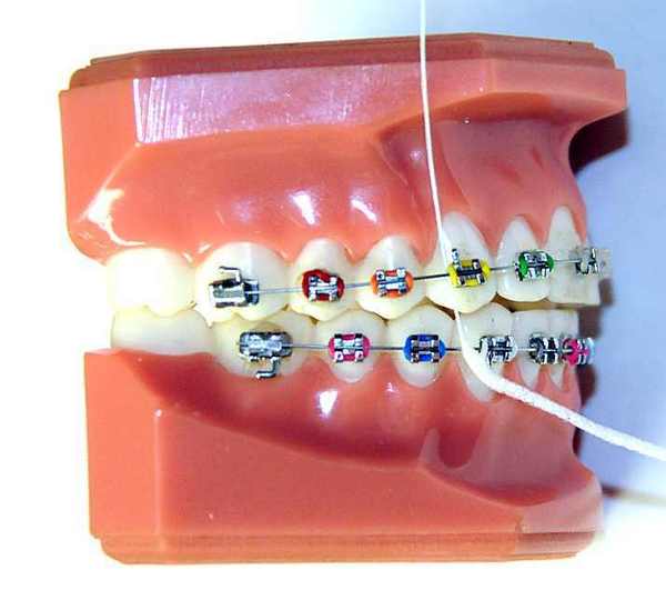 Суперфлос: це зубна нитка для чищення зубів, Кричав Бі Супер флосс, що таке Oral B Super floss?