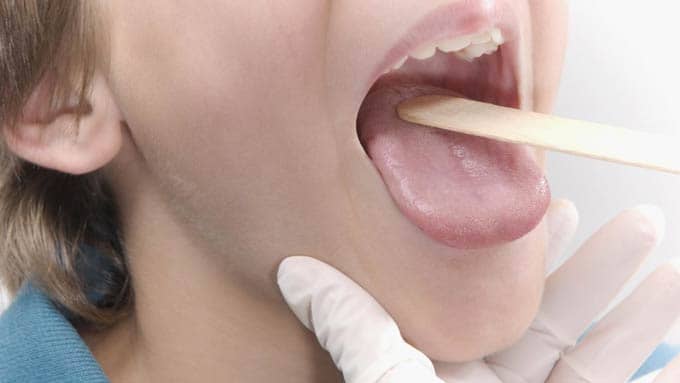 Білий наліт на язиці   причини виникнення у дітей і дорослих