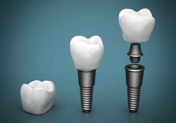 Імплантація зубів: етапи, встановлення зубного імпланту, що встановлюють, як відбувається поетапно, покроковий опис і терміни