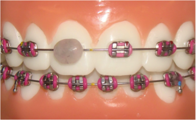 Віск для брекетів: як користуватися стоматологічним, використовувати на зубах, чим замінити в аптеці ортодонтичний медичний