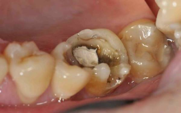 Лікування пульпіту молочних зубів у дітей: що це таке, як лікувати тимчасові одне відвідування або видаляти, етапи, де вилікувати