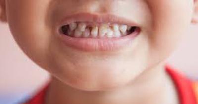 Причини карієсу у дітей, симптоми виникнення у молочних зубів