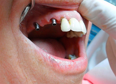 Імпланти жувальних зубів корінних: що це, як виглядають, плюси, мінуси зубного лікування, чим небезпечні керамічні, тимчасові види