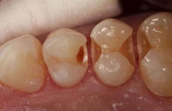 Як лікують карієс між зубами: лікування міжзубного і контактного поразки у жувальних