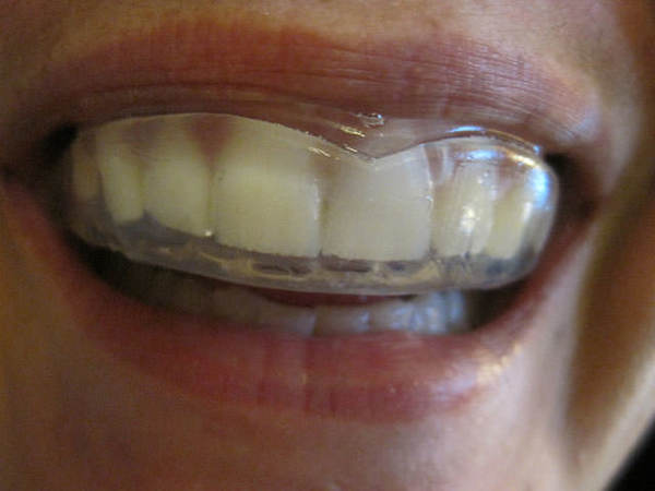Кап після брекетів: скільки потрібно і обовязково носити після зняття брекетів, фото спортивних ретейнера для зубів, що краще