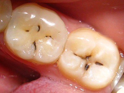 Зубний біль при карієсі до і після лікування. Біль після глибокого карієсу.