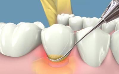 Лікування періодонтиту в домашніх умовах: симптоми, як лікувати болю, може пройти сам при полосканні зуба содою