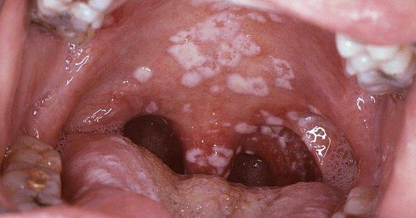 Стоматит: заразний чи ні у дітей, як передається від дитини, інкубаційний період у роті, чи можна заразитися цим дорослому