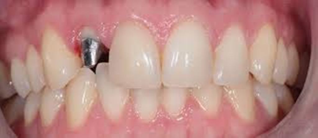 Карієс передніх зубів. Лікування і профілактика карієсу передніх зубів.